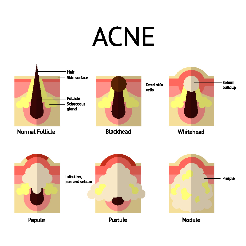  - What kind of acne is your teen dealing with? What might be causing it?